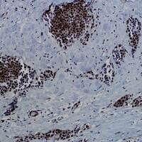 First comprehensive look at breast cancer in Native American women reveals key genetic differences